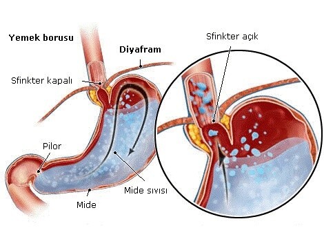 Asit Reflü İçin En İyi ve En Kötü İçecekler