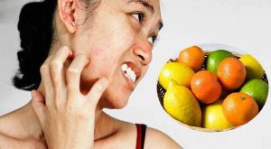 Turunçgil Alerjisi: Mekanizmalar, Tanı ve Yönetim