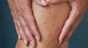 Toz Piresi Isırığı Belirtileri Nelerdir? Toz Piresi Tedavisi