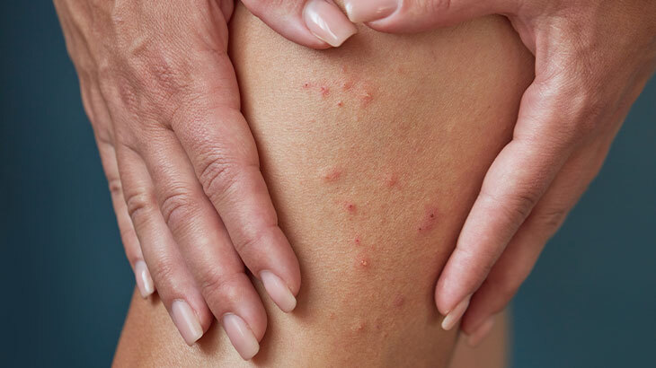 Toz Piresi Isırığı Belirtileri Nelerdir? Toz Piresi Tedavisi