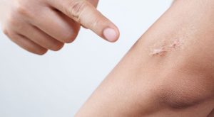 Keloid İzlerinden Kurtulmak Mümkün mü?