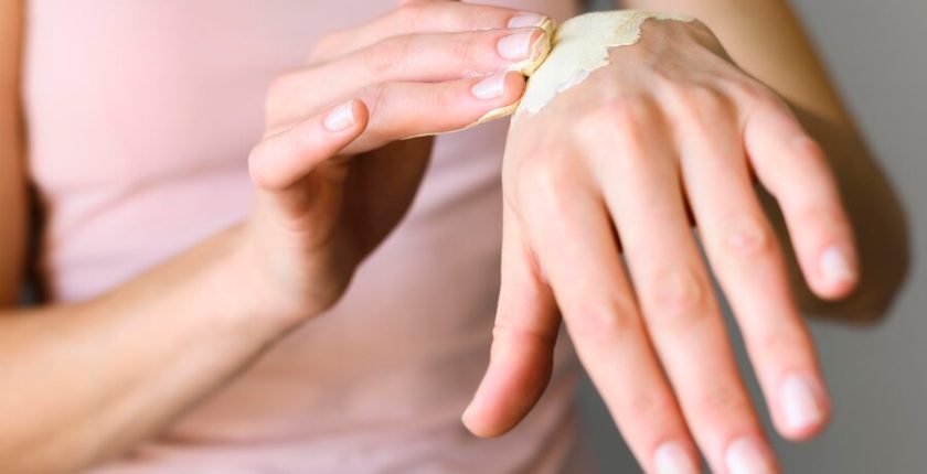 Kireç Yanığı Nedir? Kireç Yanığı Nasıl Geçer?