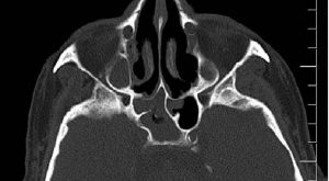 Sfenoid Kemik Nedir?