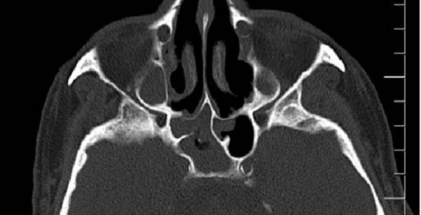 Sfenoid Kemik Nedir?