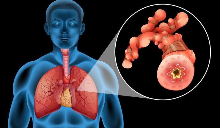 Akciğer Yağlanması Neden Olur?