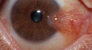 Gözde Et Büyümesi Neden Olur?