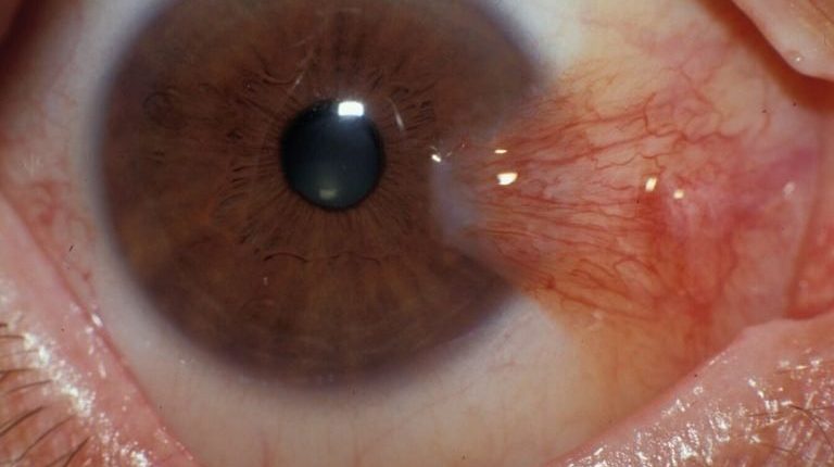 Gözde Et Büyümesi Neden Olur?