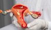 Trakelektomi (Trachelectomy) Nedir?